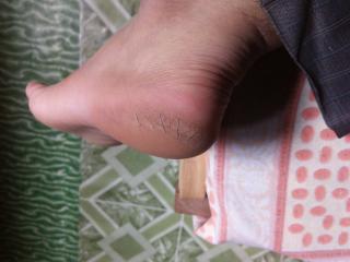 My dry,rough cracked heel 3 of 7