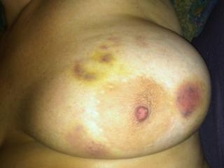 Tied and bruise breast 6 of 6