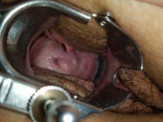 More Speculum and Cervix pics 14 of 17