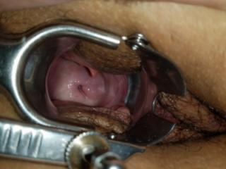 More Speculum and Cervix pics 15 of 17