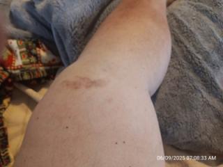 61old what hurt knee looks like other pics 7 of 8