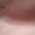 Wife's crusty toes