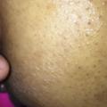 Anal prep - stage 2