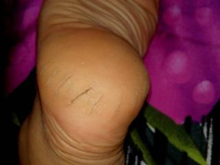 My dry,rough cracked heel 6 of 7